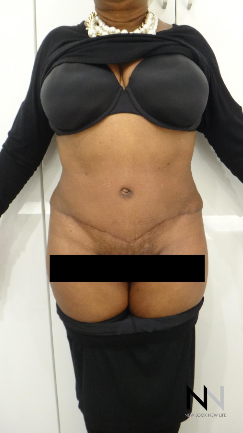 Abdominoplasty: Patient 22 - After 1