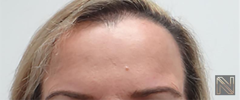 BOTOX® Cosmetic: Patient 2 - After  