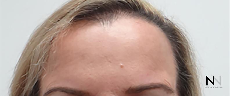 BOTOX® Cosmetic: Patient 2 - After 1