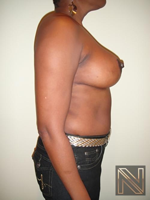 Breast Reduction: Patient 5 - After 5