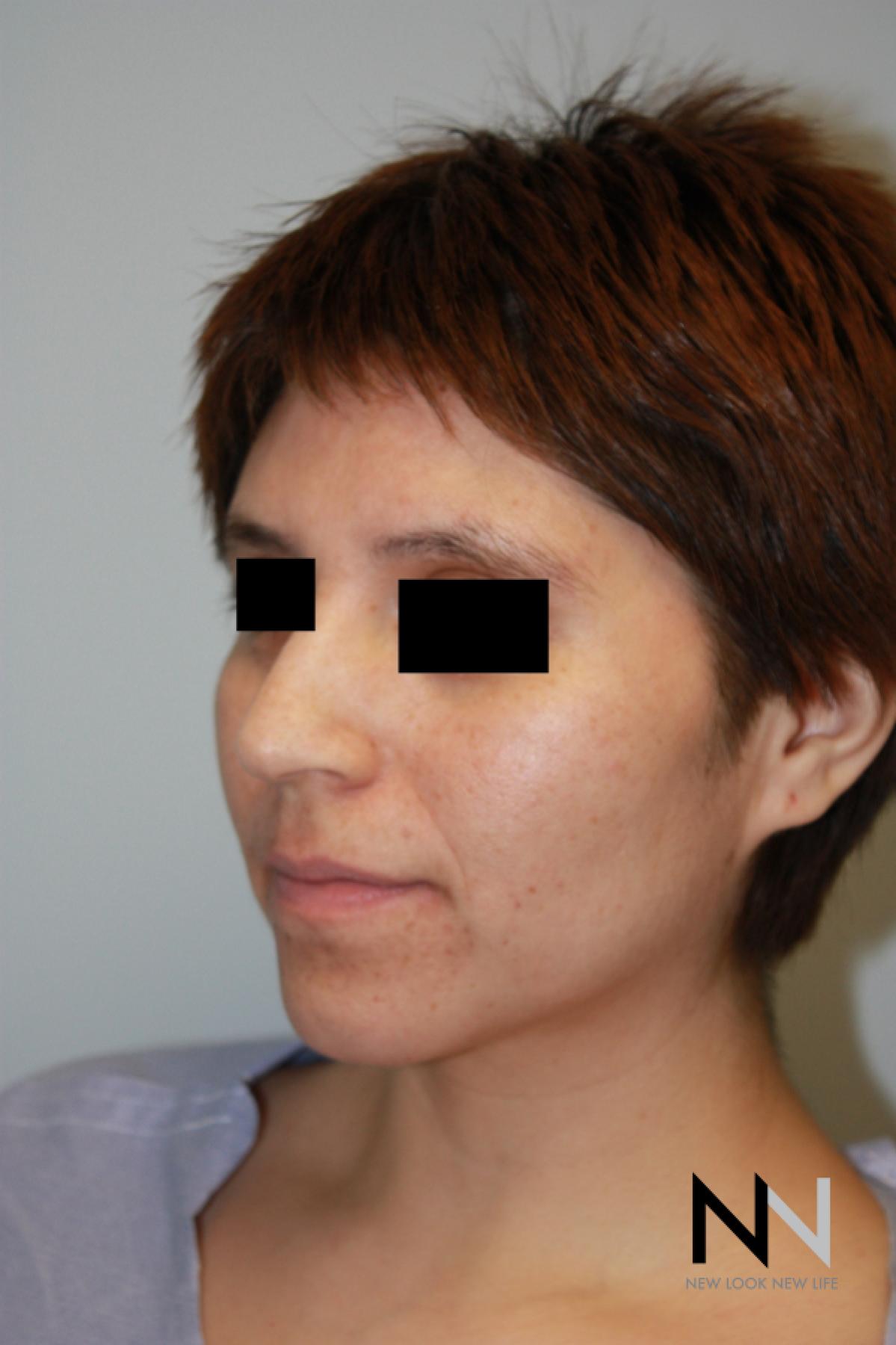 Rhinoplasty: Patient 5 - Before and After 3