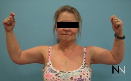 Brachioplasty: Patient 4 - After Image 1
