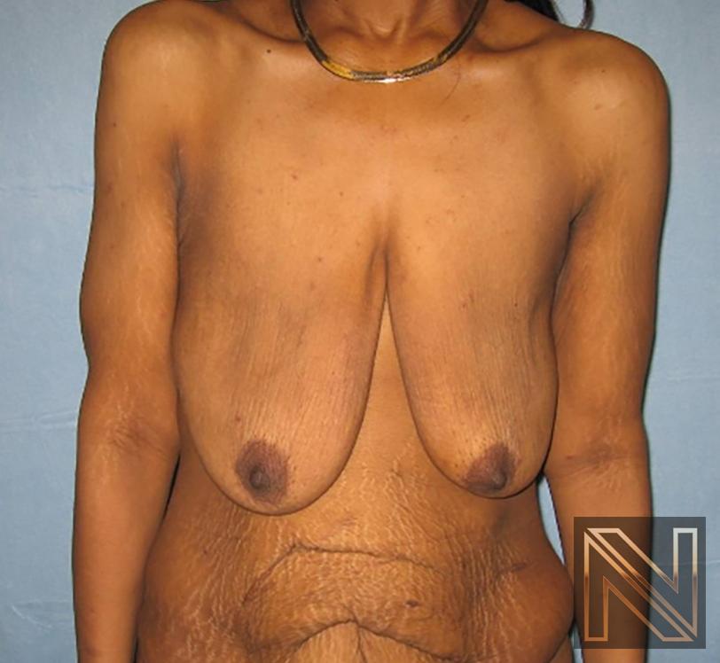 Breast Lift: Patient 13 - Before 1