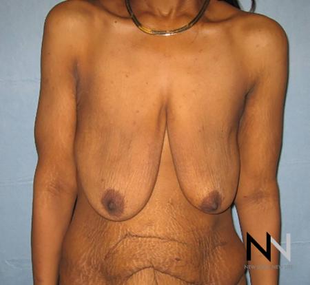 Breast Lift: Patient 13 - Before Image 1