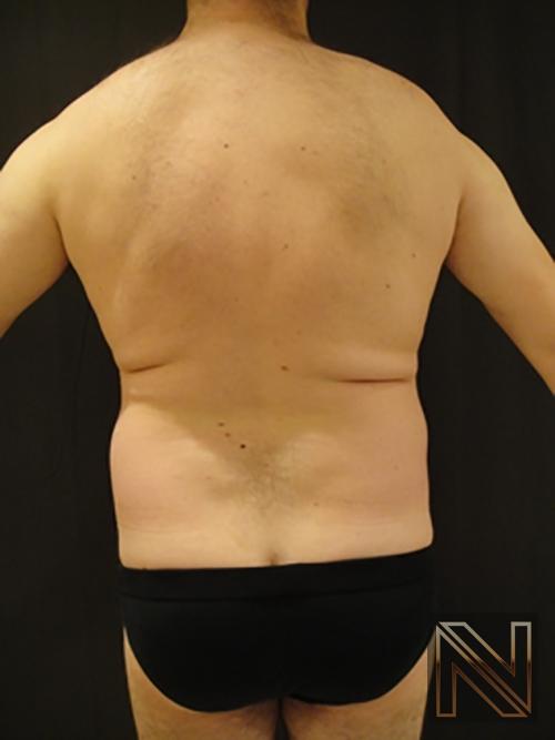 Liposuction: Patient 17 - Before and After 3