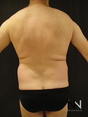 Liposuction: Patient 17 - Before and After Image 3