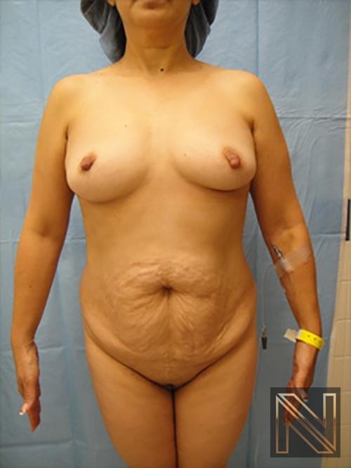 Abdominoplasty: Patient 20 - Before 1