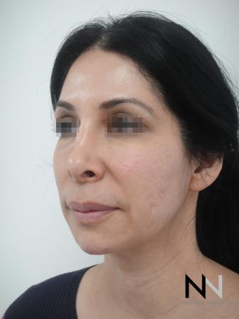 Fractional Resurfacing: Patient 3 - Before Image 1