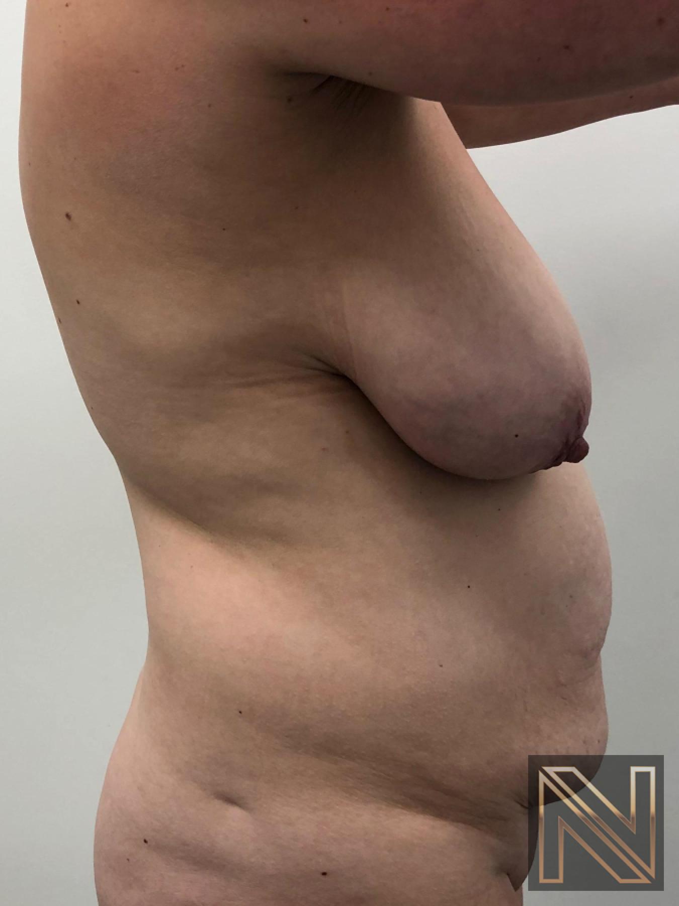 Abdominoplasty: Patient 28 - Before and After 3