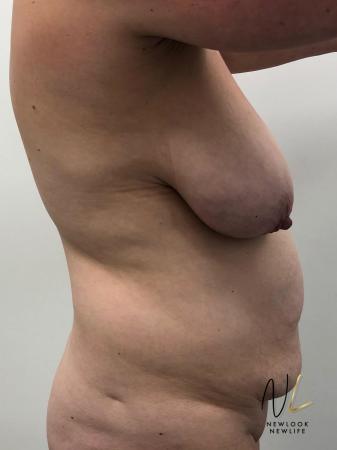 Abdominoplasty: Patient 28 - Before and After 3