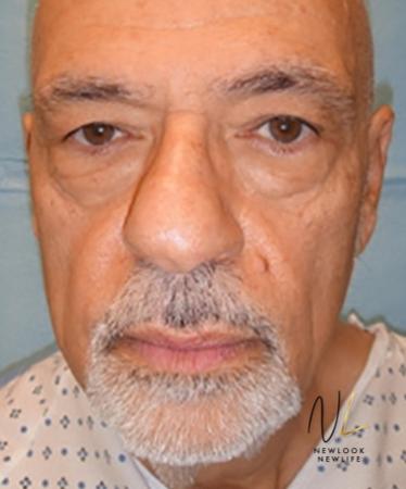 Blepharoplasty: Patient 3 - Before Image 1