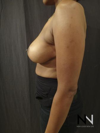 Breast Lift: Patient 2 - After Image 3