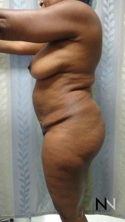 Abdominoplasty: Patient 22 - Before and After 2