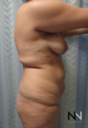 Butt Augmentation: Patient 5 - Before and After Image 3