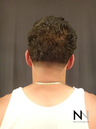 Otoplasty And Earlobe Repair: Patient 2 - After Image 1
