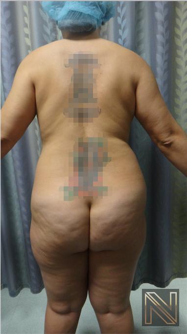 Liposuction: Patient 15 - Before and After 4