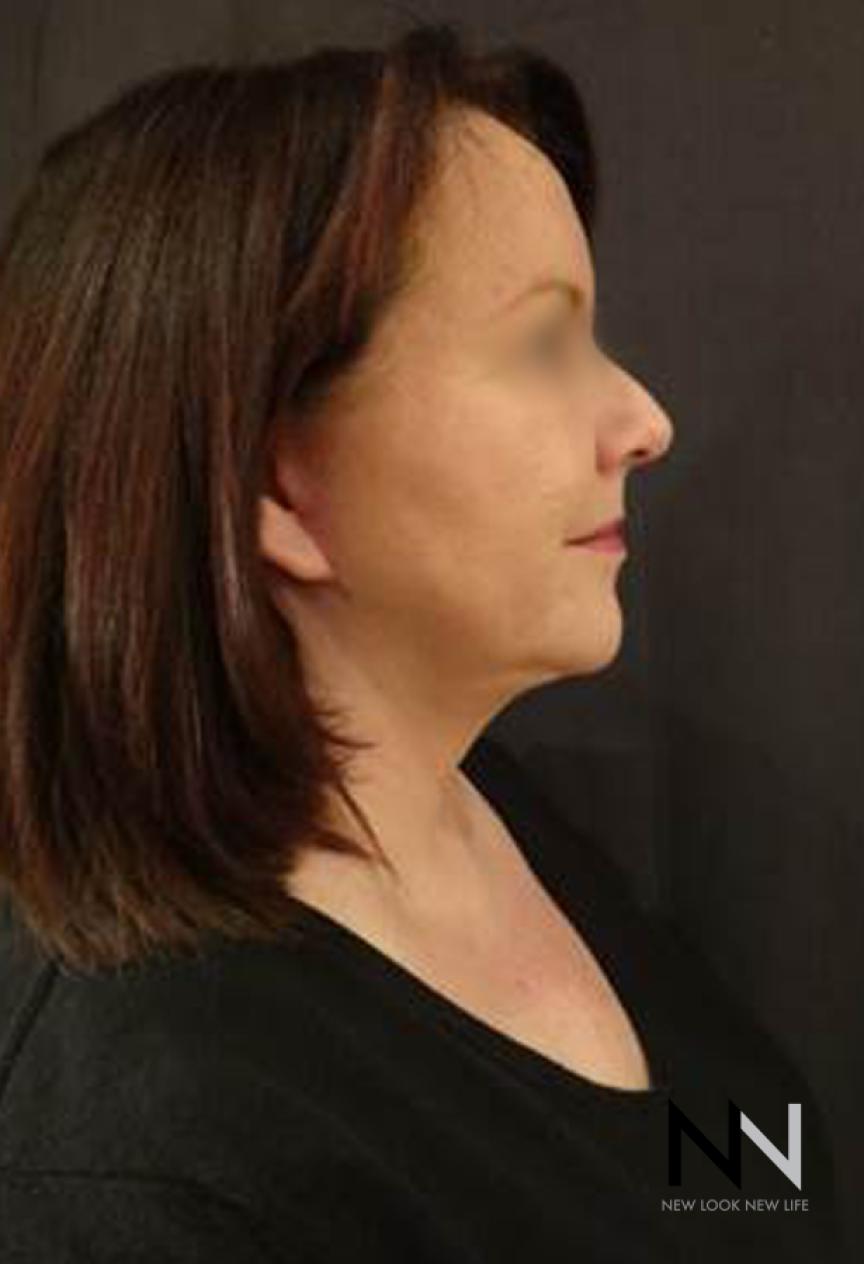 Facelift/Mini Facelift: Patient 4 - After 1