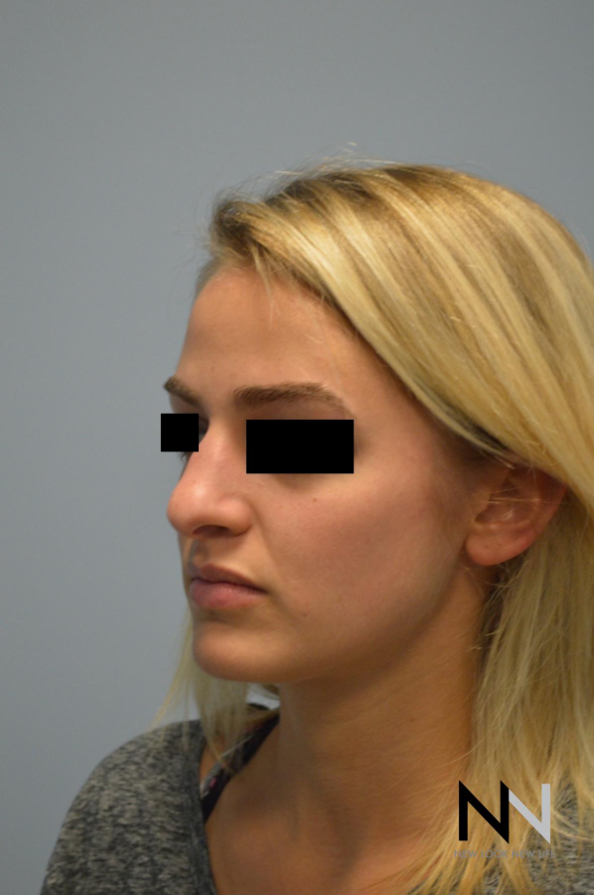 Rhinoplasty: Patient 3 - Before 2