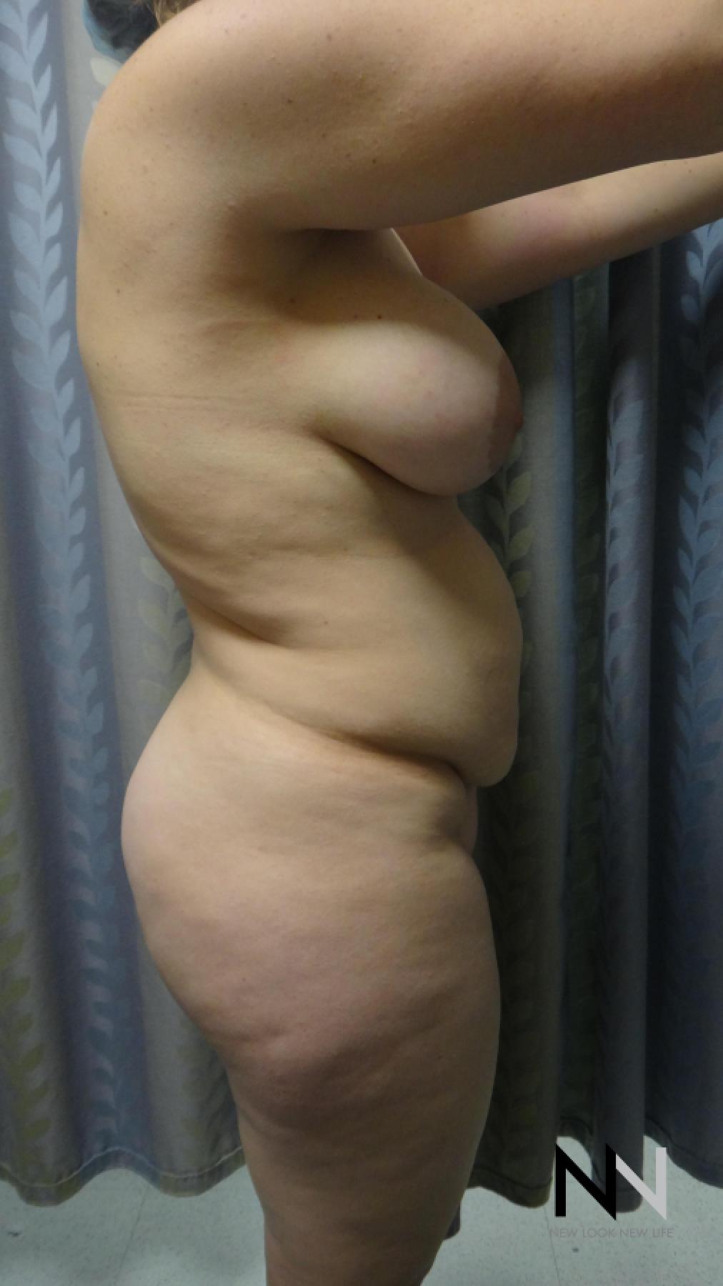 Abdominoplasty: Patient 24 - Before 3