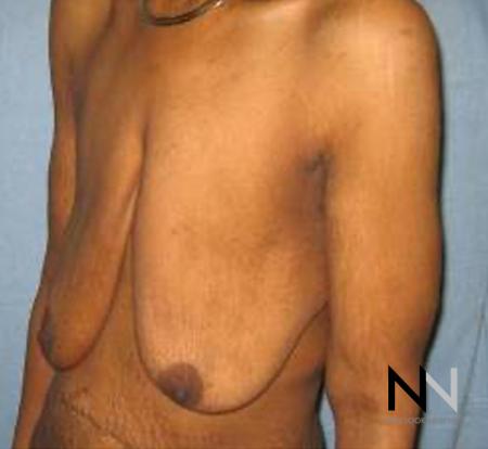 Breast Lift: Patient 13 - Before and After Image 3
