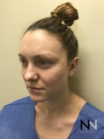 Fractional Resurfacing: Patient 4 - Before Image 3