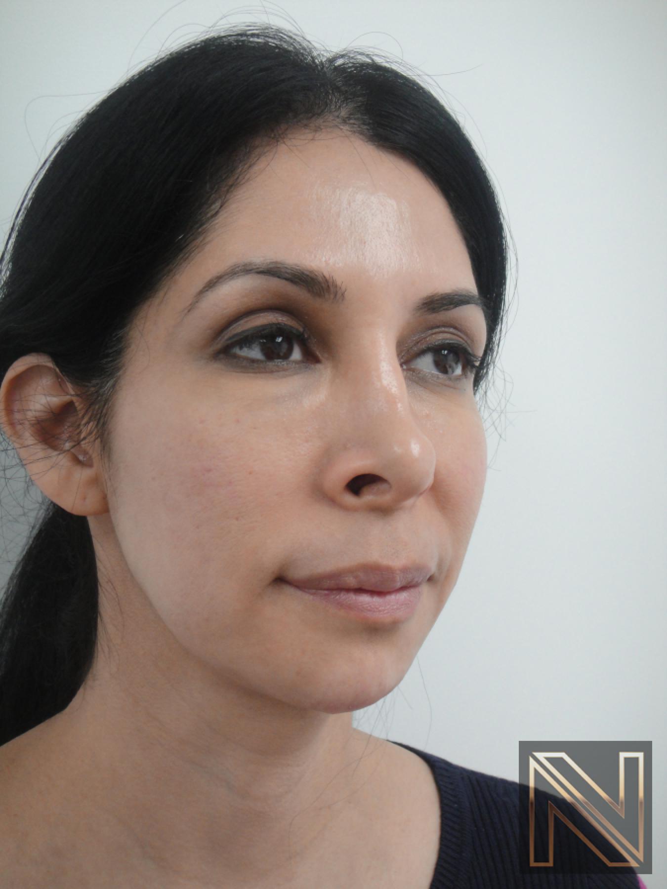 Fractional Resurfacing: Patient 3 - Before and After 2