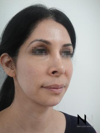 Fractional Resurfacing: Patient 3 - Before and After Image 2