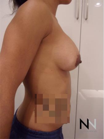 Breast Augmentation: Patient 18 - After Image 2