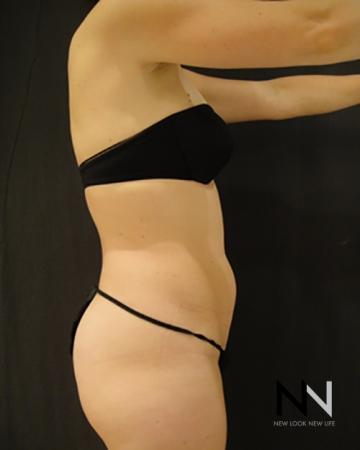Liposuction: Patient 8 - Before and After Image 3