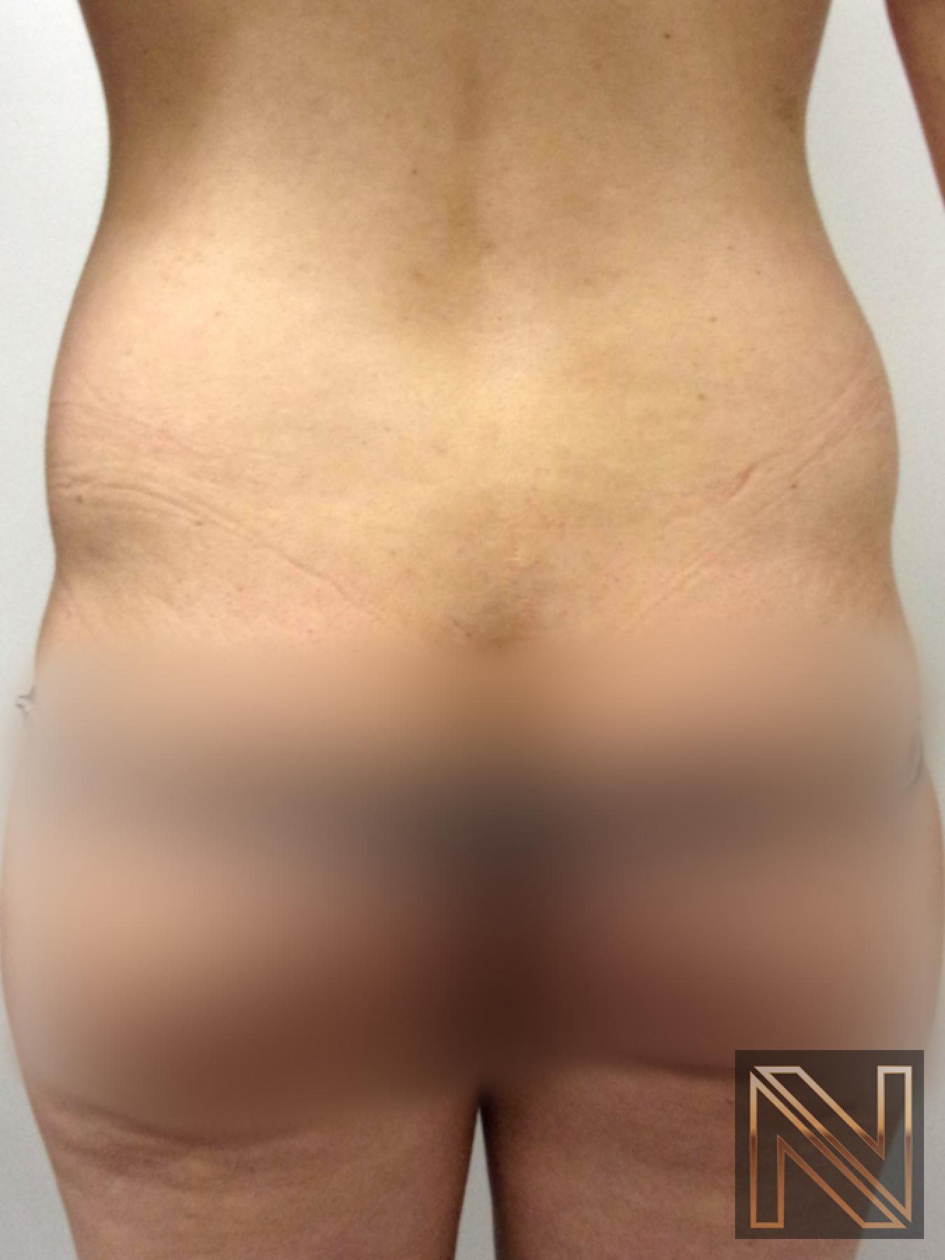 Liposuction: Patient 22 - Before 1