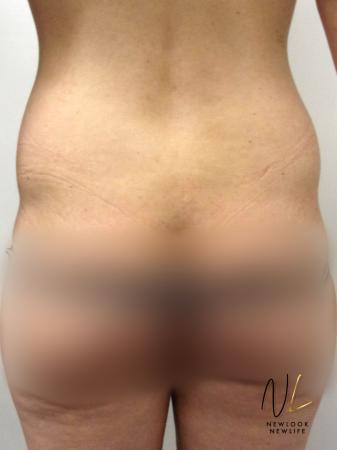 Liposuction: Patient 22 - Before Image 1