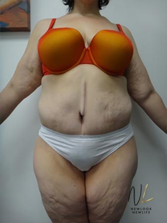Abdominoplasty: Patient 12 - After 1