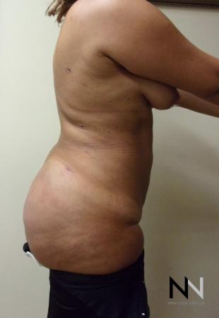 Butt Augmentation: Patient 5 - After Image 3