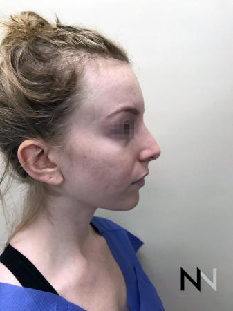 Halo™: Patient 2 - Before Image 3