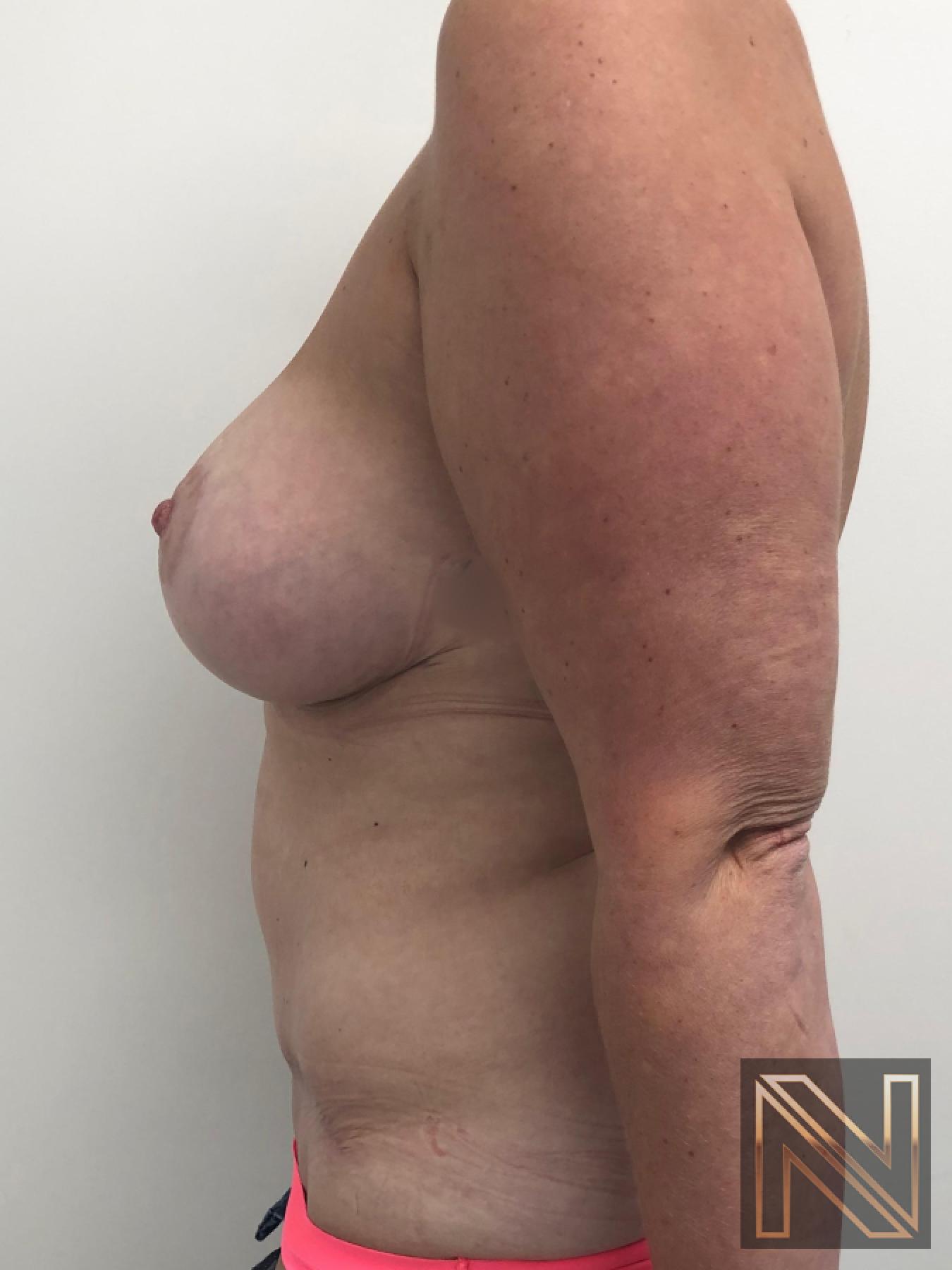 Abdominoplasty: Patient 28 - After 2