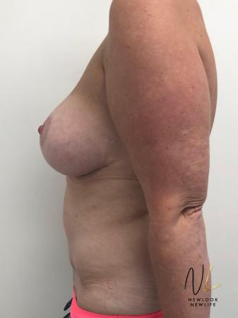 Abdominoplasty: Patient 28 - After 2