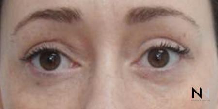 Blepharoplasty: Patient 8 - After Image 1
