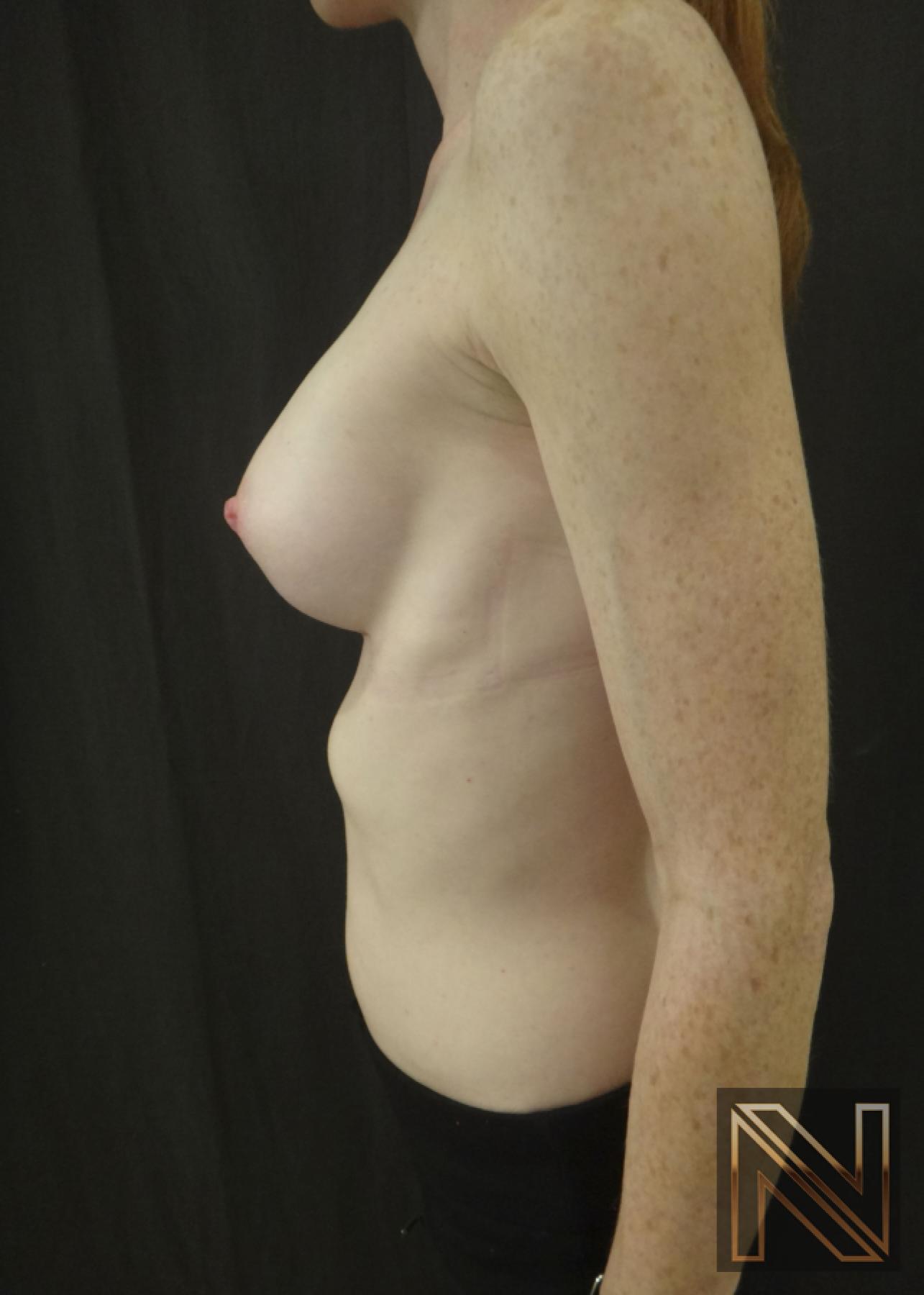 Breast Augmentation: Patient 17 - After 5