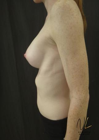 Breast Augmentation: Patient 17 - After Image 5