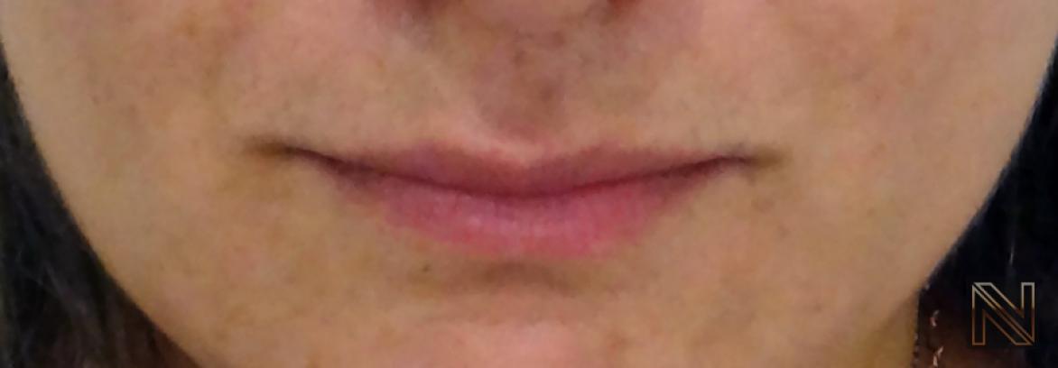 Fillers: Patient 5 - Before 