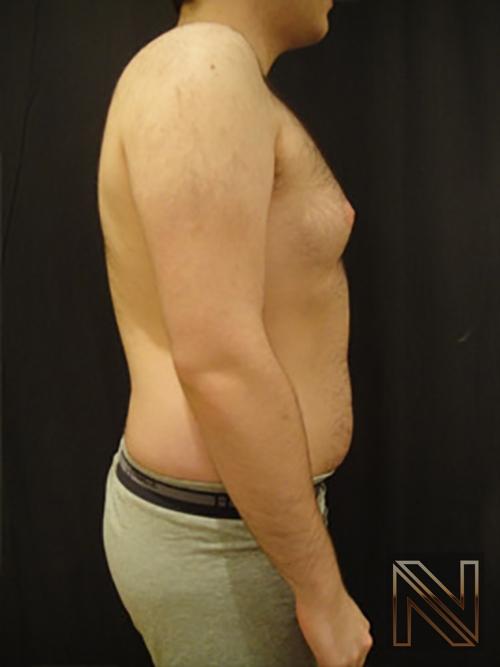 Gynecomastia: Patient 5 - Before and After 4