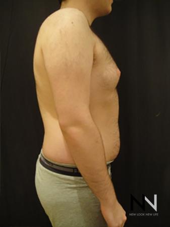Gynecomastia: Patient 5 - Before and After Image 4