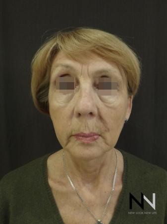 Ultherapy®: Patient 2 - Before Image 1