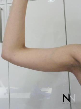 Liposuction: Patient 26 - After Image 1
