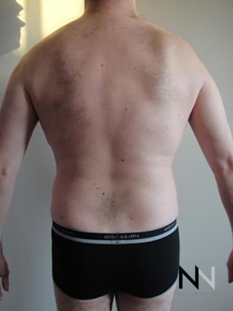 Liposuction: Patient 17 - After Image 3