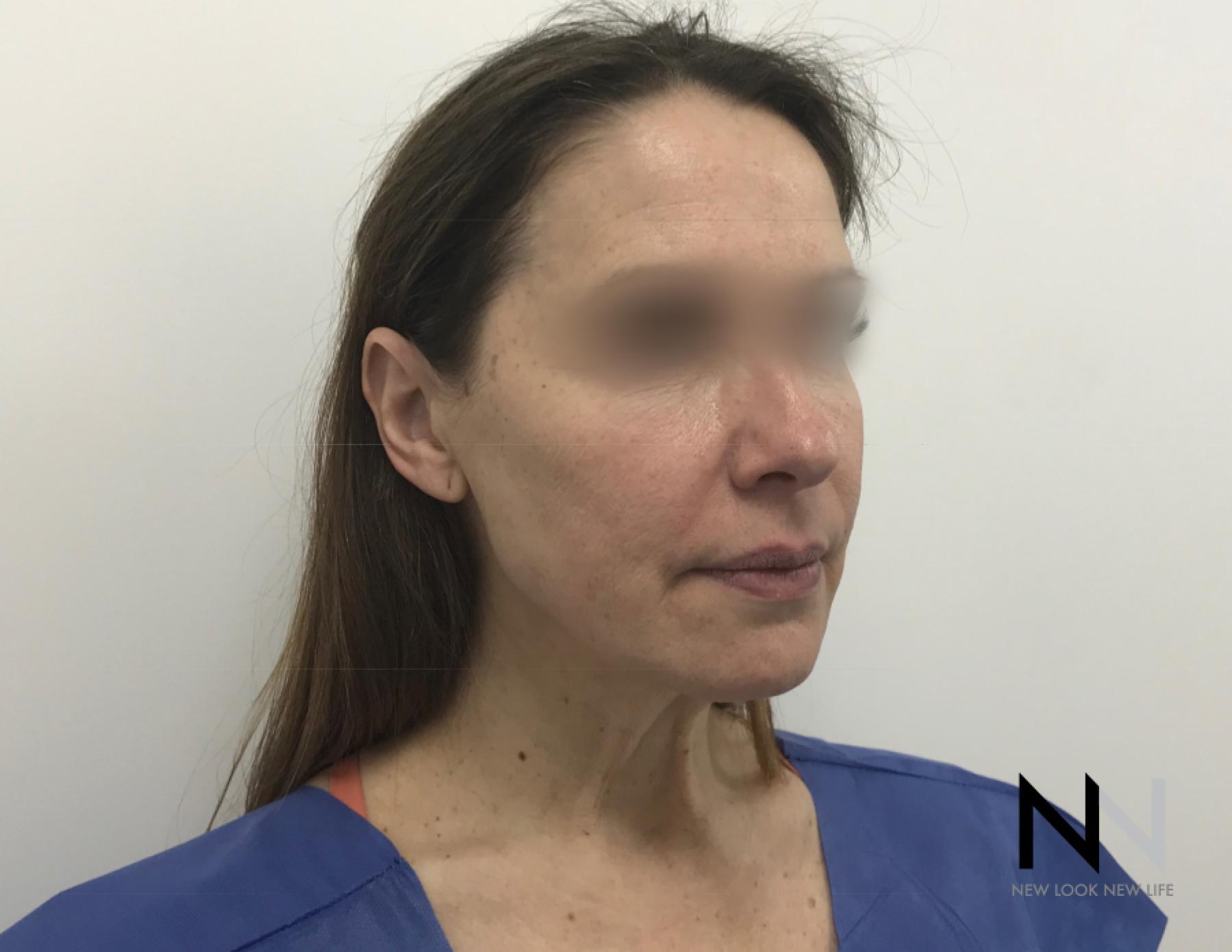 Facelift/Mini Facelift: Patient 5 - Before 1