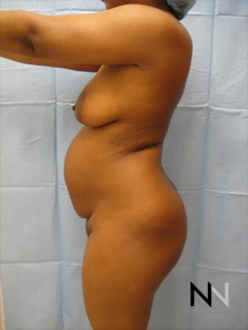 Abdominoplasty: Patient 7 - Before 2