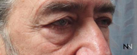 Blepharoplasty: Patient 7 - Before Image 2