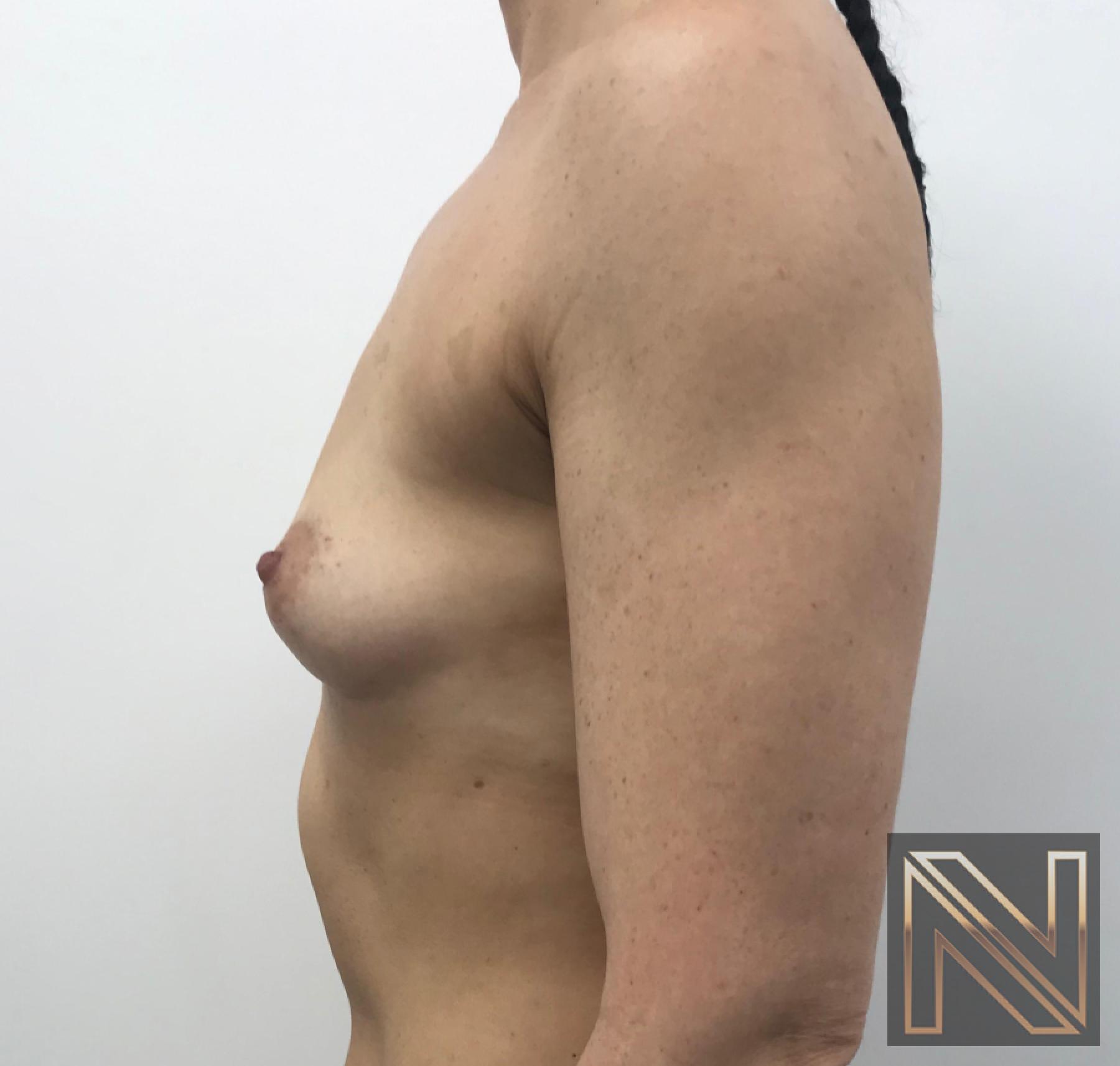 Breast Augmentation: Patient 2 - Before 2