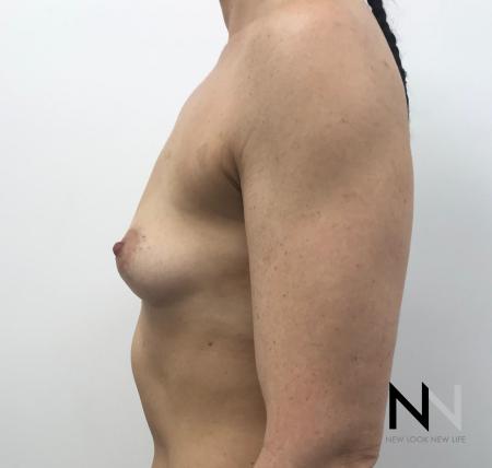 Breast Augmentation: Patient 2 - Before Image 2